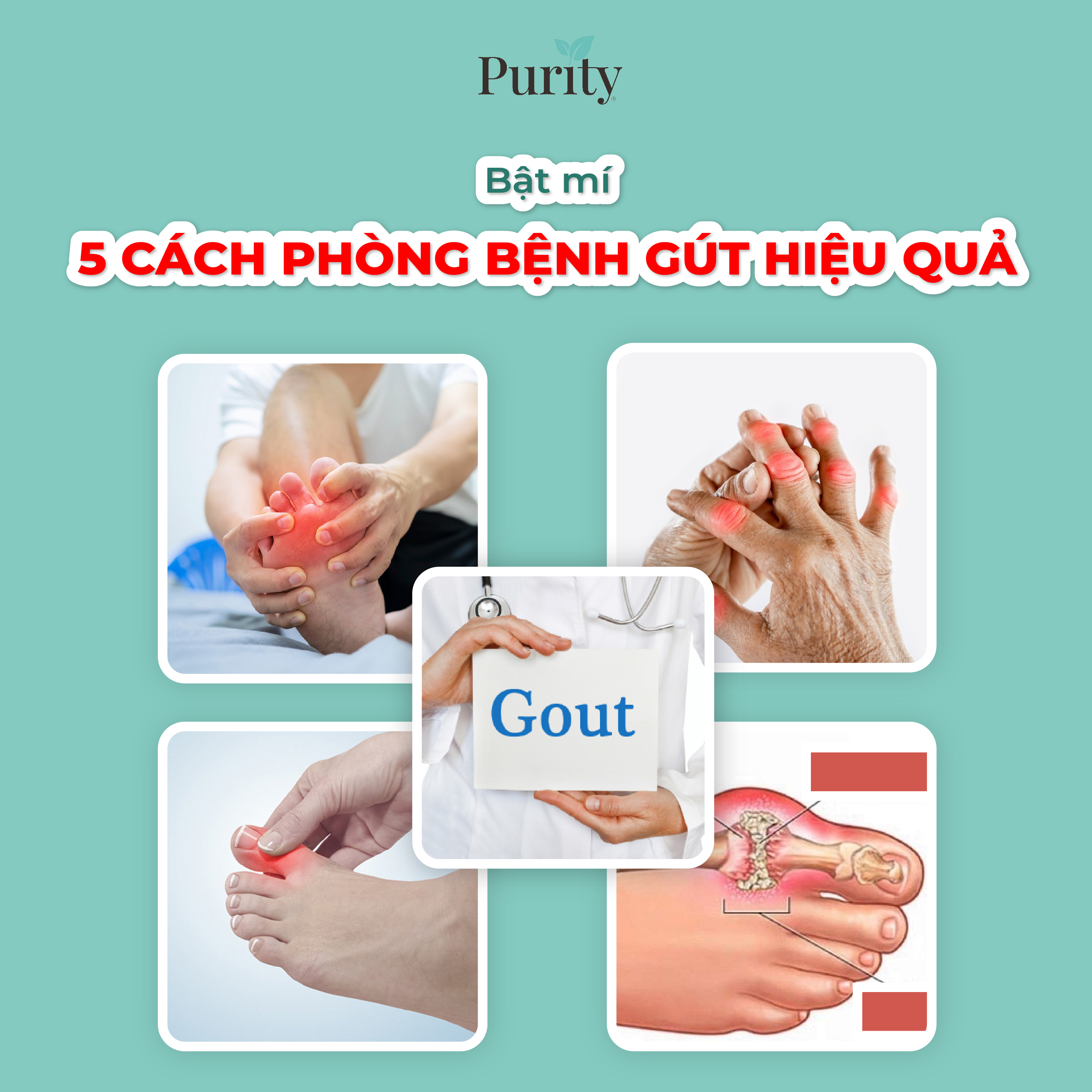 BẬT MÍ 5 CÁCH PHÒNG BỆNH GÚT HIỆU QUẢ