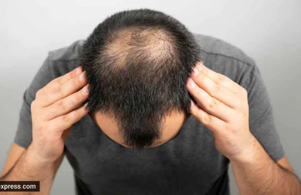 6 Best Treatments for Severe Hair Loss