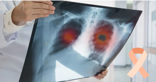 Don't Let Your Guard Down, Recognize the Early Signs and Symptoms of Lung Cancer